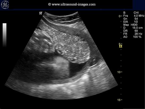 Fundal Placenta Ultrasound