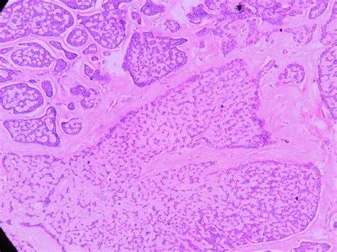 Adenoid cystic carcinoma – Histopathology.guru