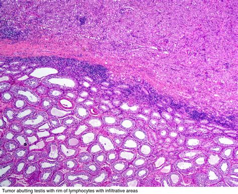 Sarcomatoid Carcinoma Lung Pathology Outlines