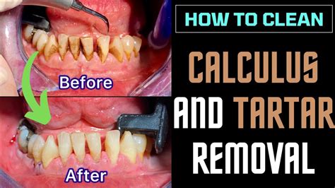 DENTAL CALCULUS and TARTAR removal - TARTRECTOMY before and after ...