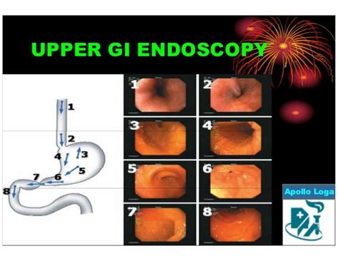 Upper GI Endoscopy - A pictorial overview