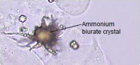 Ammonium biurate crystals | Medical Laboratories