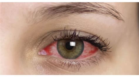 Anterior Uveitis: Causes, Symptoms and Treatment | OBN