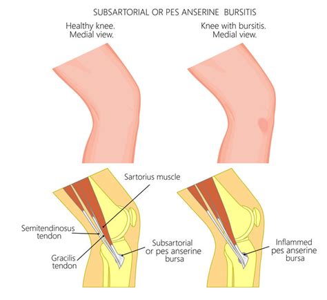 Medial Knee Pain Tysons | PA Pathology | Physical Therapist Falls Church