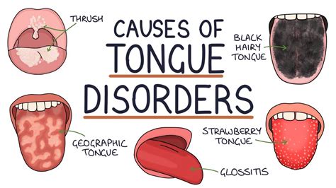 Understanding Tongue Disorders: Causes and Management - YouTube