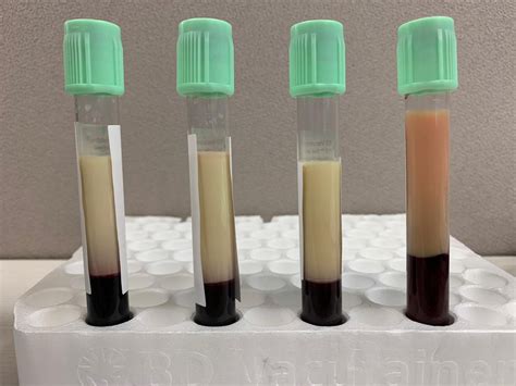 Demonstration of patient's blood separating into two distinct layers ...