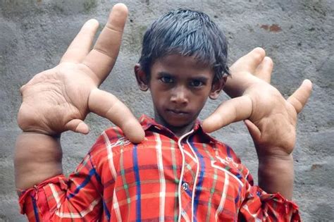 'Boy with the World's Biggest Hands' measuring 33cm has surgery to reduce their size - World ...