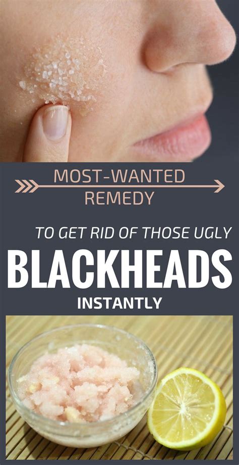 You can get rid of blackheads with a simple and effective mask that can be prepared at home ...