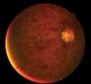 Neovascular Glaucoma Stages