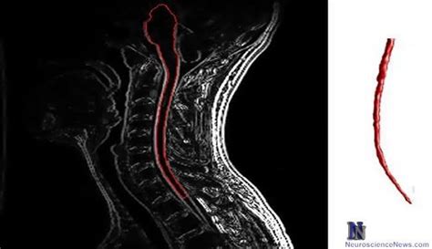 Hopes for Reversing Age-Associated Effects in MS Patients - Neuroscience News