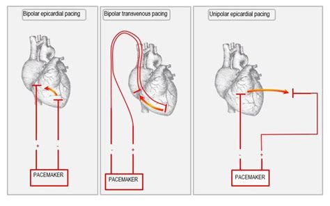 Pin by nonas arc on Epicardial pacing wires | Physiology, Circuit, Anatomy