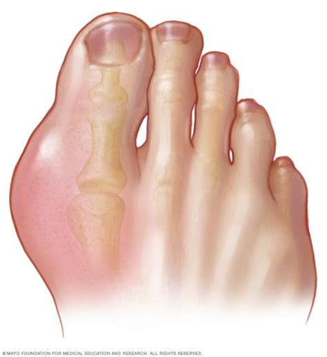 Gout - Mayo Clinic