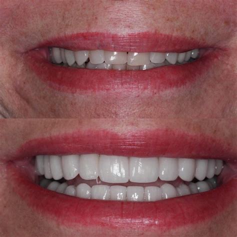 Before and after full mouth reconstruction. An experience you can trust ...