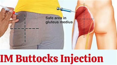 How to give gluteal muscle injection at home intramuscular injection ...