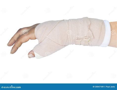 Broken wrist in a cast stock image. Image of bruising - 20047189