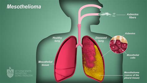 Mesothelioma Symptoms And Causes 2023: How To Cure?