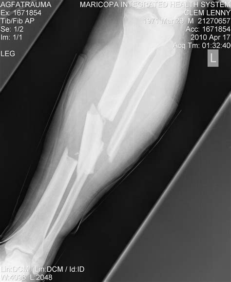 Compound Fracture - Fracture Treatment