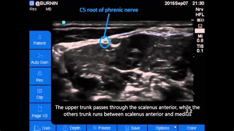 Ultrasound Scalene block, upper trunk variation - YouTube