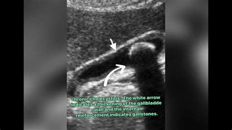 Cholelithiasis ,Murphy's sign,Gallbladder wall thickening• Gallbladder ...