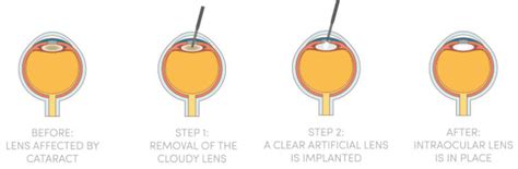 Cataract Surgery in Las Vegas Henderson NV