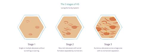 Hidradenitis Suppurativa Stages - HidraWear