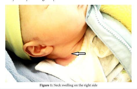 Figure 2 from Fibromatosis Colli, a Rare Cause of Neck Mass in Infants: A Case Report | Semantic ...