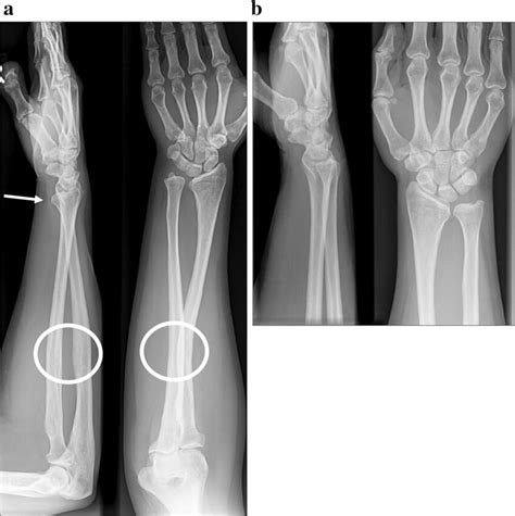 a A complete forearm radiograph shows malunion at the shaft level... | Download Scientific Diagram