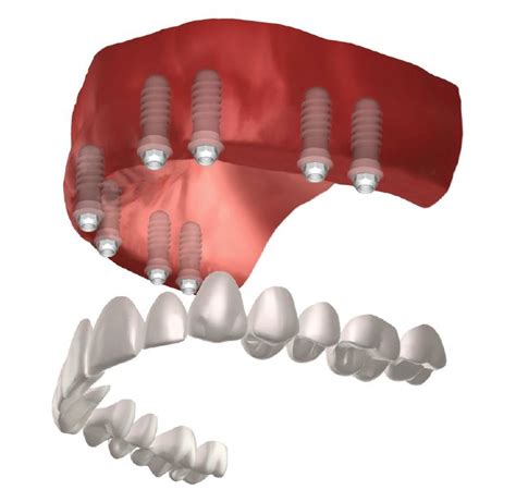 Full Mouth Implants - Derby Dentists