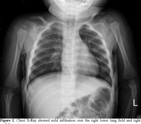 [PDF] Bacterial Tracheitis : A case report | Semantic Scholar