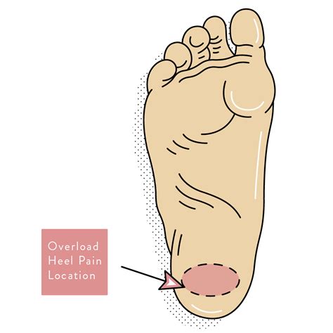 Heel Pain | Causes, Types and Podiatry Treatment