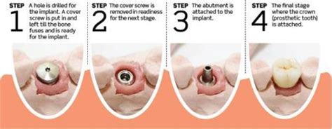 Dental Implants in Coarsegold CA | Golden Hills Dental