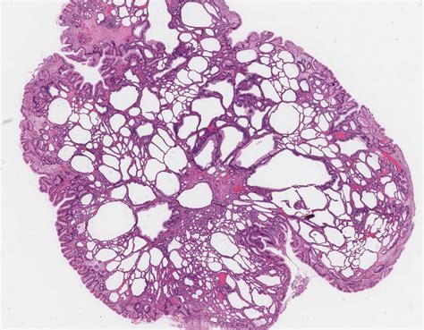 Inflammatory polyp of the stomach - MyPathologyReport.ca