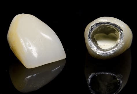 PFM Crowns | PFG Crowns | Dental Lab Atlanta