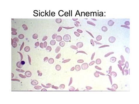 Sickle Cell Anemia Blood Smear