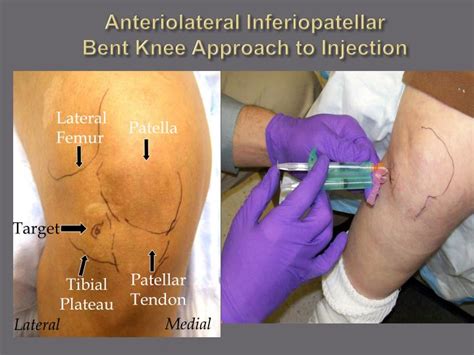 PPT - Arthrocentesis and Joint Injection for the Internist PowerPoint Presentation - ID:1111504