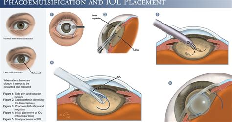 Biomedical Engineering: Very Clear Illustration Regarding Phaco-Cataract Surgery