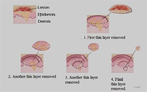 Treatment of skin cancer by surgery | Download Scientific Diagram