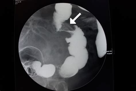 Apple-core lesion of the colon shown on barium enema (a | OPENi