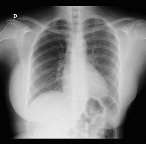 Hemihyperplasia | Eurorad