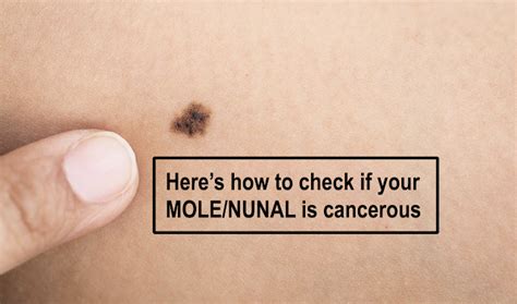 How To Know If Your Moles Are Cancerous or Not: Signs and Symptoms - ArtikuloBlogazine