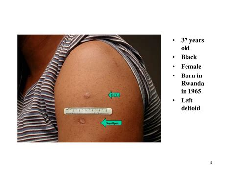 PPT - Recognition of BCG Scars PowerPoint Presentation, free download - ID:3764793