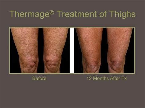 100+ ideas to try about Thermage | Plastic surgery, Beauty tips and Medical