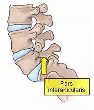 What is Spondylolysis/Pars Defect? Causes, Symtoms, Diagnosis