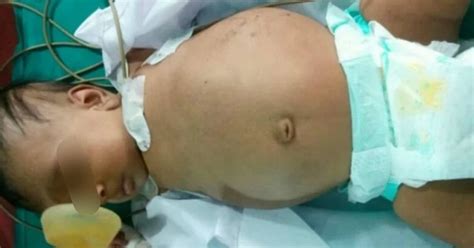 Parasitic Twin: Parents Mistake Their Baby for A Tumour