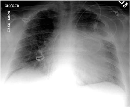 Anterior–posterior one view chest X-ray depicting enlarged... | Download Scientific Diagram