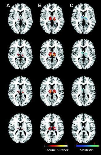 67 HD Lacune Brain Mri - insectza