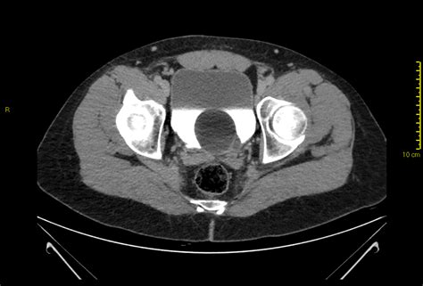 Ureterocele in adult man | Eurorad