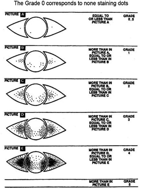 Oxford Scale For Corneal Staining | My XXX Hot Girl