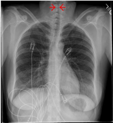 Croup | Concise Medical Knowledge