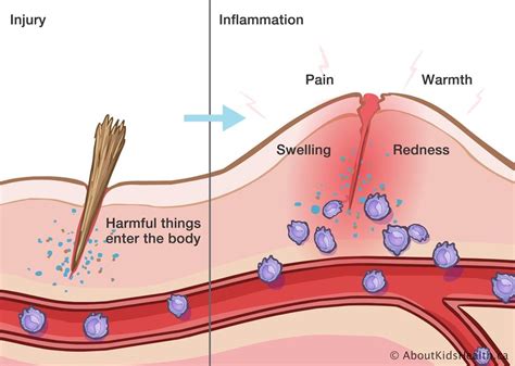 The inflammatory process and how to use it to our benefit — Brill Physical Therapy